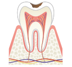 C1、C2/軽度の虫歯