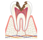 C3/神経までの虫歯