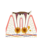 C3/神経までの虫歯